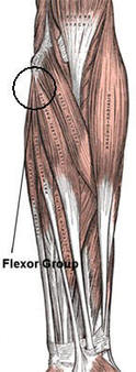 Golfer's Elbow, Elbow Tendinosis, Medial Epicondylitis