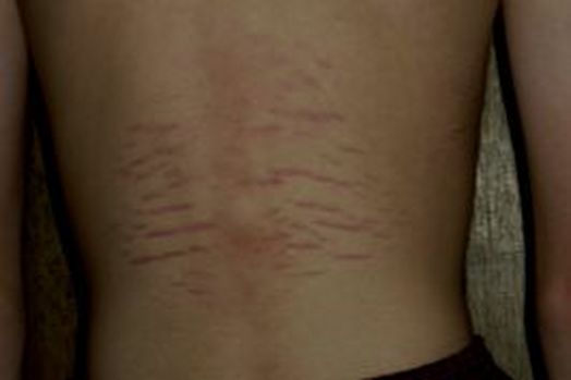 Stretch Mark Pain