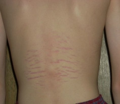 Stretchmarks Hypertrophic Scars