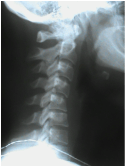 X-ray Reverse Neck Curve