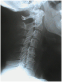 Cervical Hypolordosis