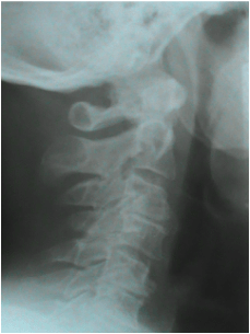 Neck X-ray Deterioration