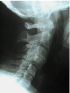 Neck X-ray Lateral Decay