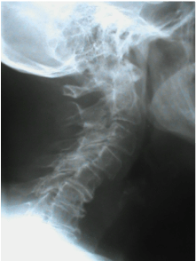 Neck X-ray Lateral