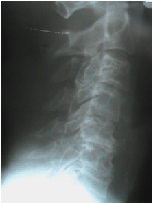 Lateral Cervical X-ray Decay