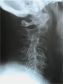 Lateral Cervical X-ray
