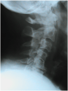 Neck X-ray Degeneration