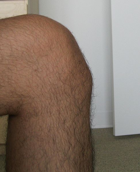 Osgood Schlatter Syndrome and Tibial Tubercle