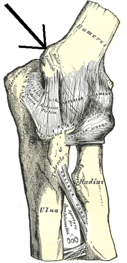 Medial Epicondylitis, Golfer's Elbow, Elbow Tendinosis