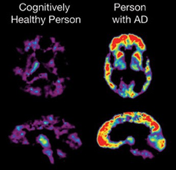 Sugar Alzheimer's Brain