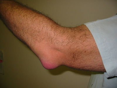 bursitis