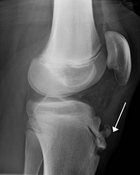 Osgood Schlatter Syndrome and Tibial Tubercle X-ray