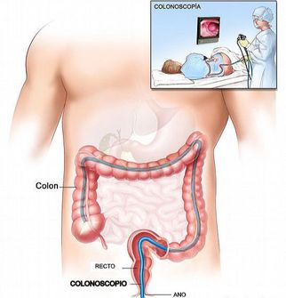 Colonoscopy Side Effects