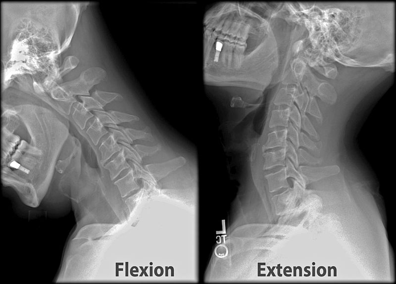 Flexion / Extension X-rays of the Cervical Spine