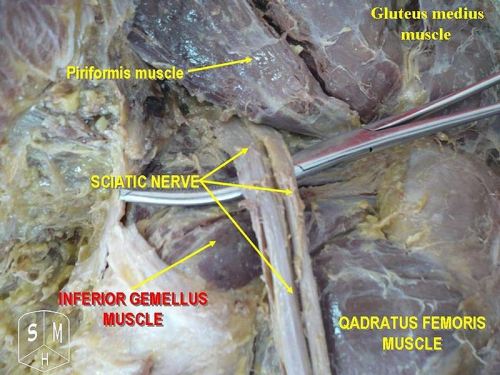 Sciatic Nerve Piriformis Syndrome