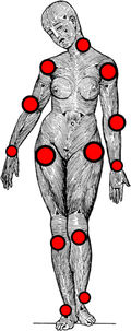 Systemic Tendinosis