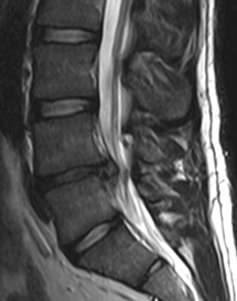 Herniated Disc Solution