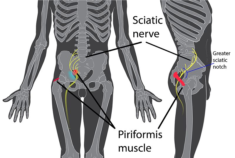 Piriformis Syndrome Can You Help Me