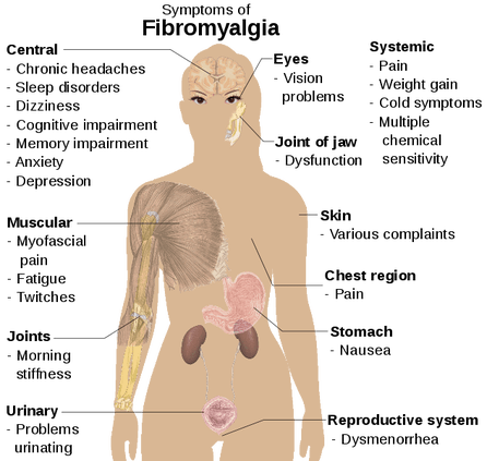 Fibromyalgia