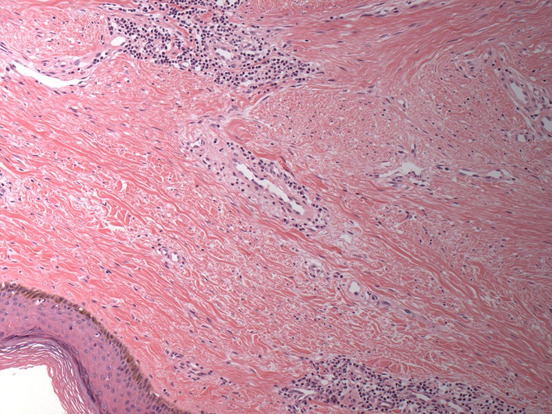 Microscopic Scar Tissue
