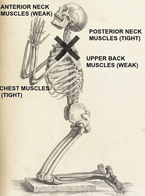 Upper Crossed Syndrome