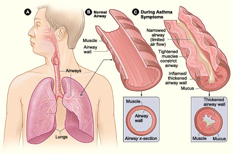 Deadly Asthma