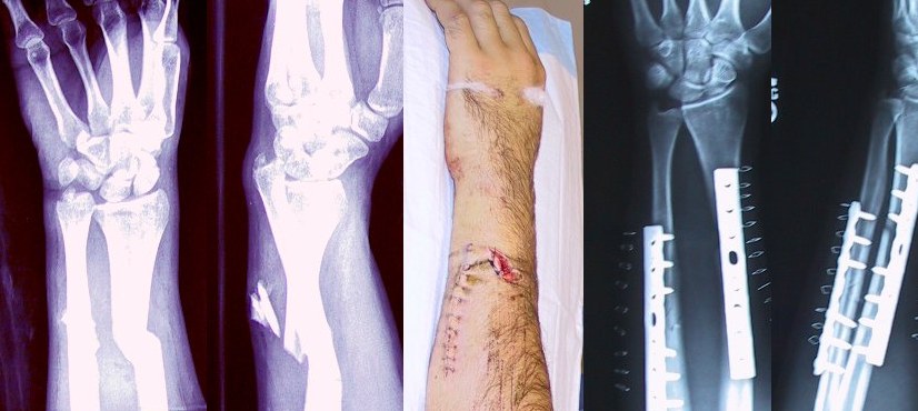 Calcium Vitamin D Fracture