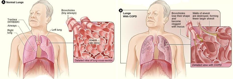 COPD Solutions