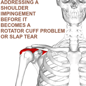 Shoulder Impingement Syndrome: Successfully Addressing the Number One ...