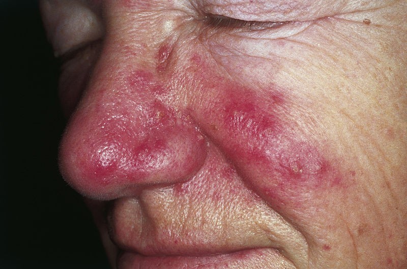 rosacea
