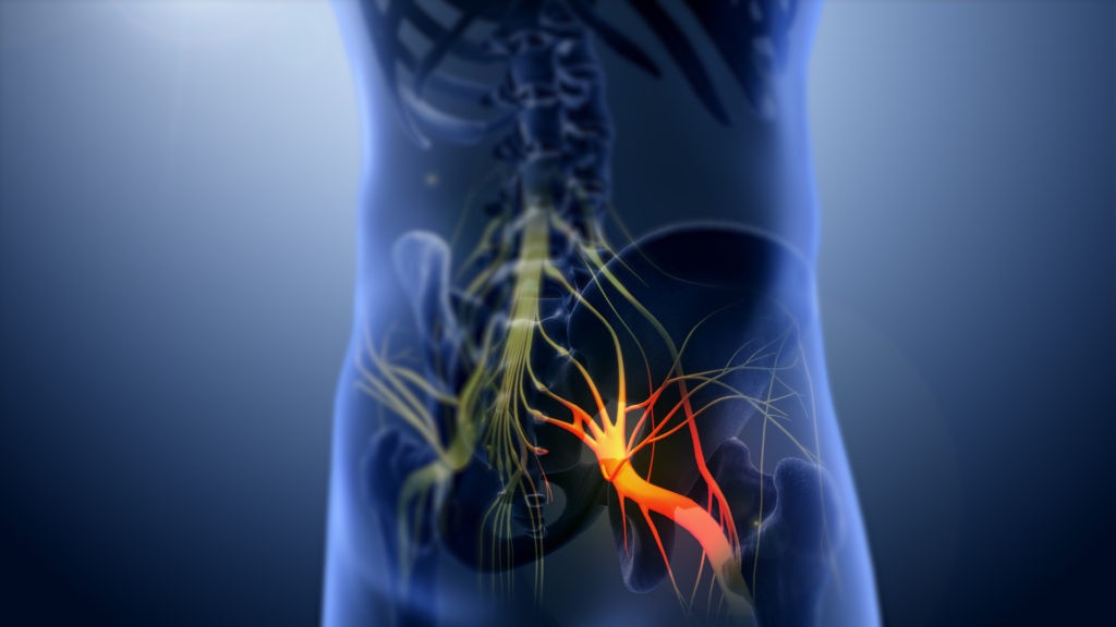 Top Ten Causes of Sciatica