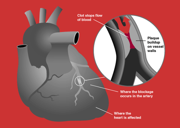 Heart Disease Prevention