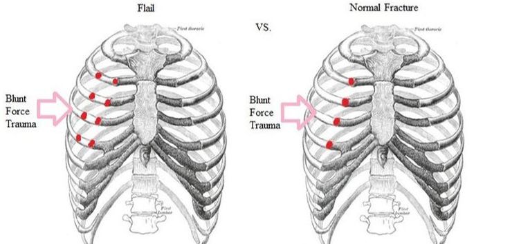 non-cardiac chest pain