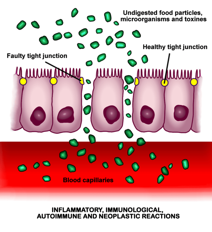 Leaky Gut Syndrome