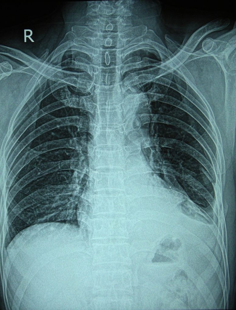 non-cardiac chest pain