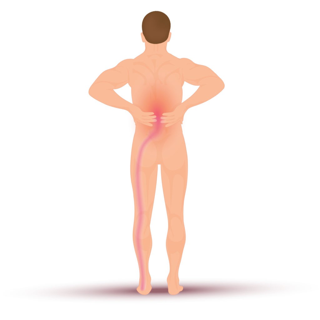 Causes of Sciatica