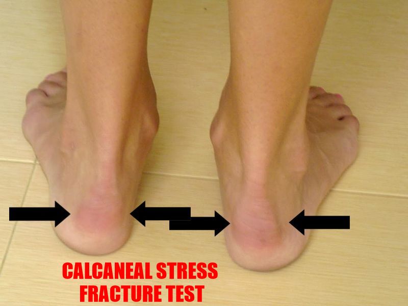 Calcaneal Stress Fracture